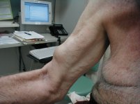 upper-biceps-rupture.JPG