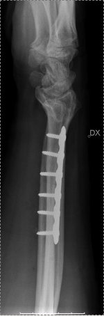 Arm.JPG
