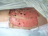 lårtagställe 2.jpg