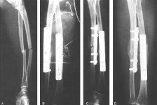 radius ulna 1.jpg