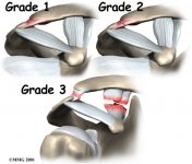 shoulder_acromioclavicular.jpg