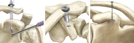 shoulder-instability-1.jpg