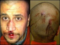 George-Zimmerman-injuries-as-not-reported-by-the-media-540x405.jpg