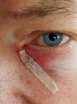 Två stygn fem mm från ögat (5) - kopia.jpg