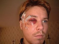 efter op[1].JPG